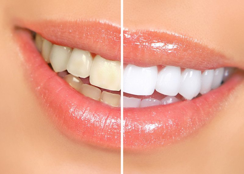 Before and after teeth